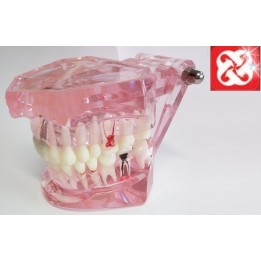 Tipodonto Con Implantes