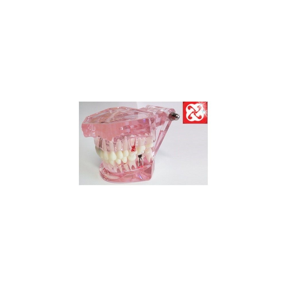 Tipodonto Con Implantes Tipodonto Con Implantes