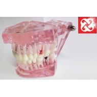 Tipodonto Con Implantes