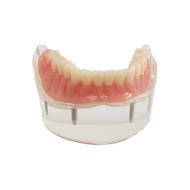 Tipodonto Prostodoncia Soportada con Implantes
