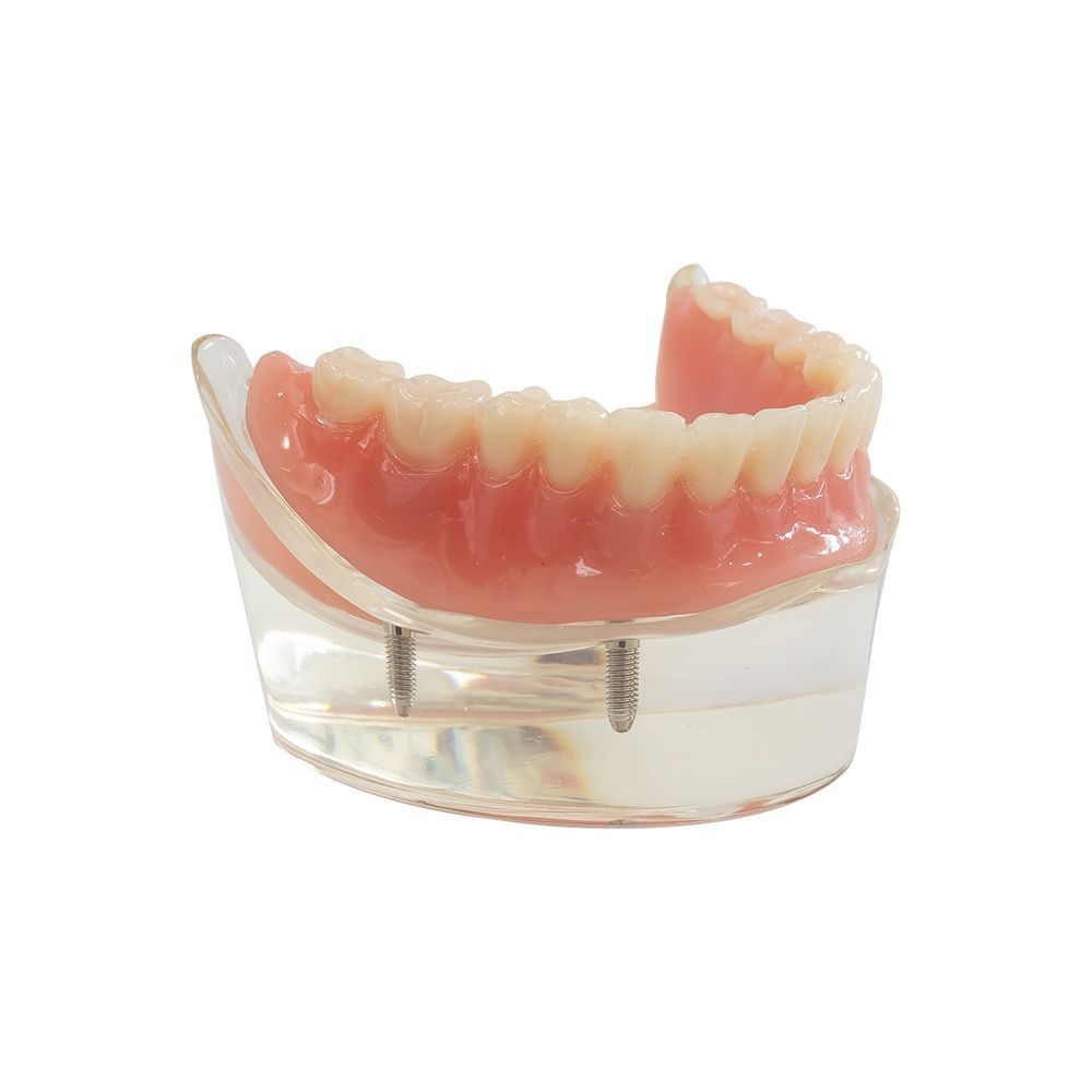 Tipodonto Prostodoncia Soportada con Implantes