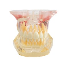 Tipodonto Con Implantes y Senos Paranasales