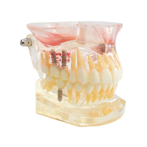 Tipodonto Con Implantes y Senos Paranasales