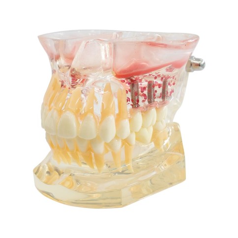 Tipodonto Con Implantes y Senos Paranasales