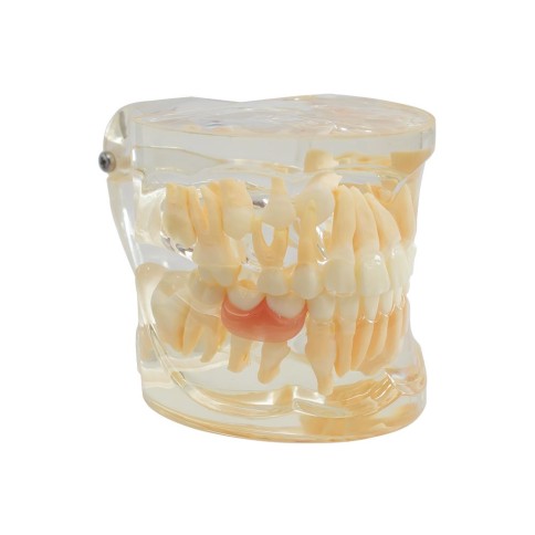 Tipodonto Dentición Infantil 6 años