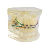 Tipodonto Con Brackets