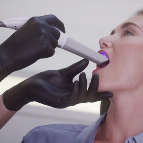 Escáner Intraoral 3D Heron IOS