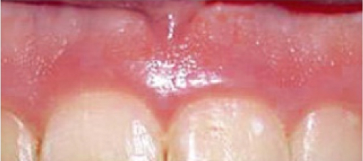 Dientes Antes