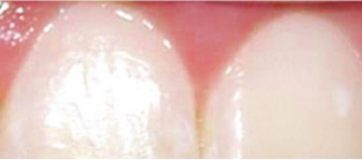 Dientes Cuatro