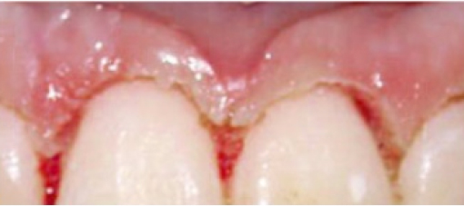 Dientes Bajo